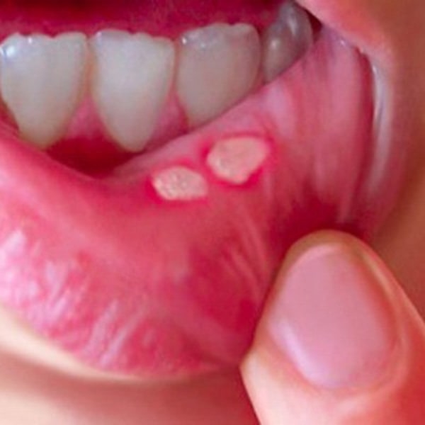 Vì sao bị nhiệt miệng thường xuyên và cách điều trị là gì?